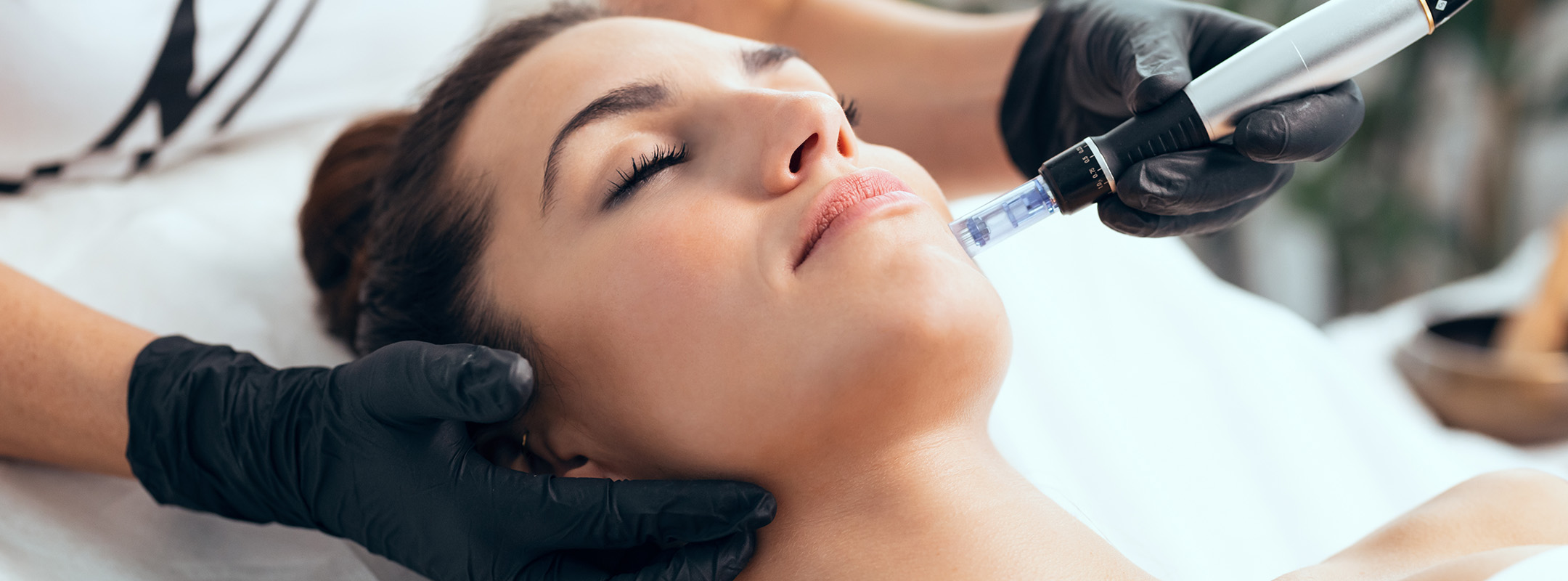 Microneedling